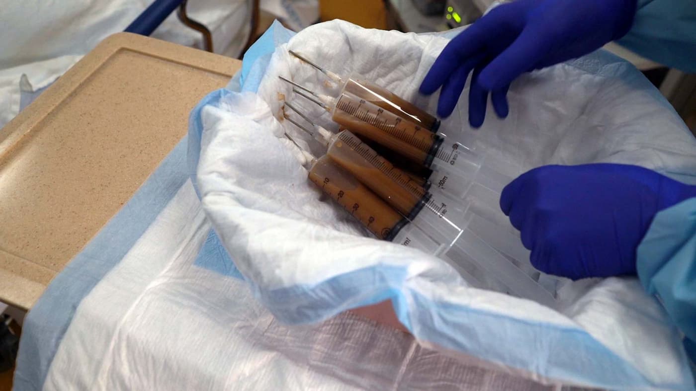 Closeup of six plastic syringes in a large bowl lined with an absorbent pad. The syringes are filled with sample-solution.